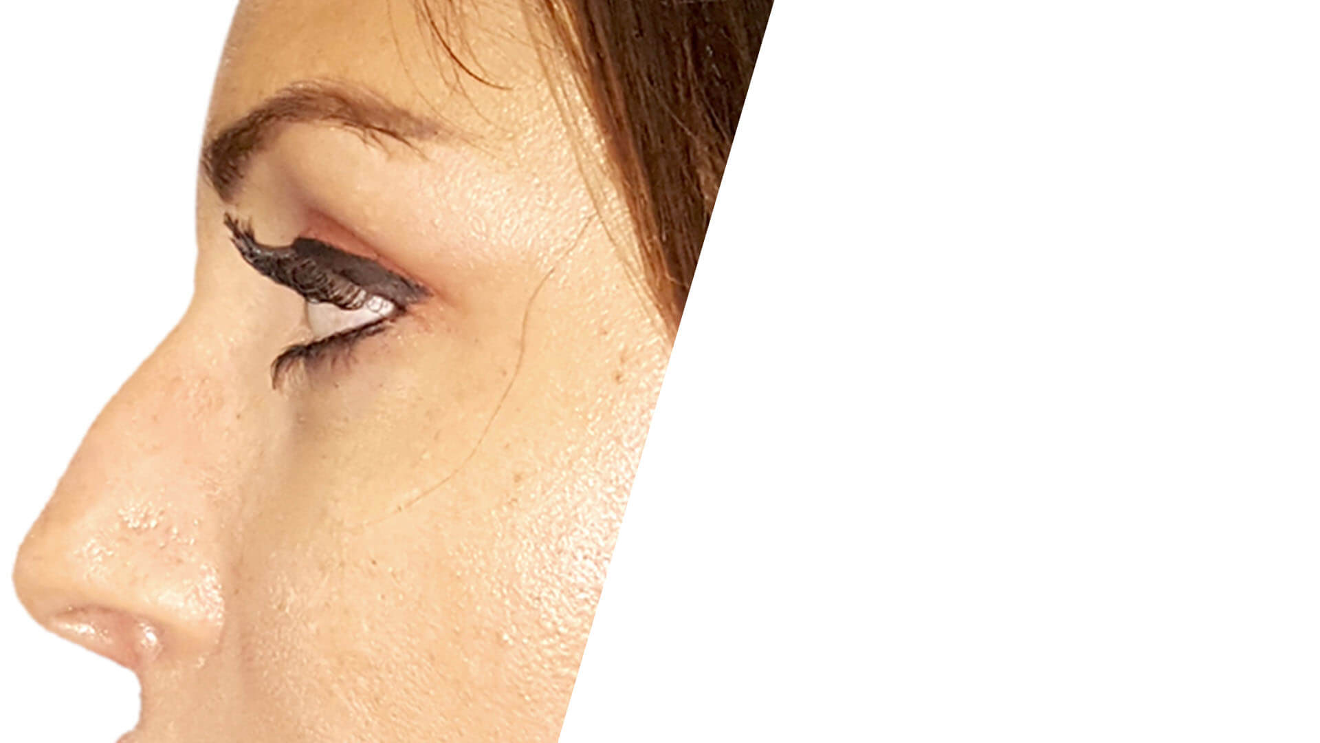 Rinofiller? Rimodella ed addolcisci il profilo naso o alza una punta