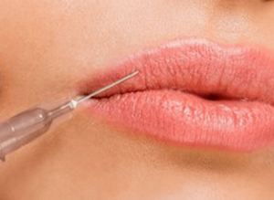 3 modi per avere le russian lips 4 russian-lips-filler