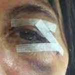 Tempi di recupero della blefaroplastica: la storia di Anna dal giorno 1 1 tempi di recupero della blefaroplastica
