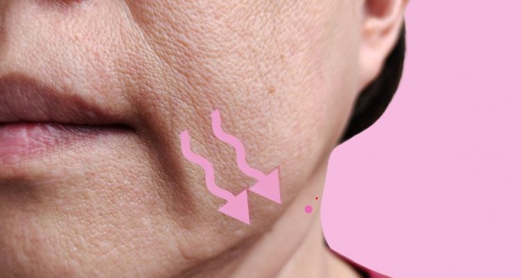 minilifting viso - profilo mandibolare, migliorare il Profilo Mandibolare, guance cadenti