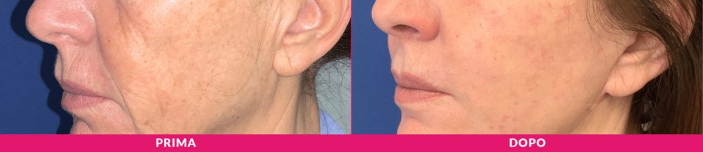 risollevare il viso, minilifting, prima dopo, come risollevare il viso milano, minilifting milano, guance cadenti