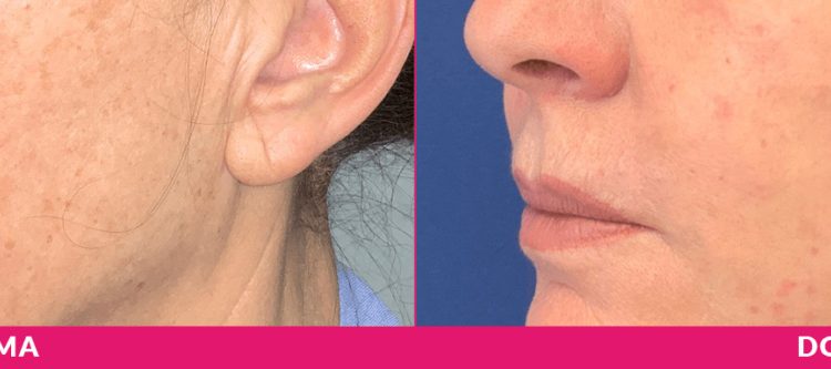 risollevare il viso, minilifting, prima dopo, come risollevare il viso milano, minilifting milano, guance cadenti, rughe naso-labiali