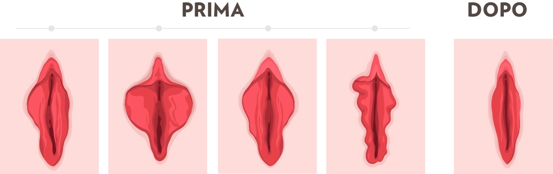 labioplastica 2