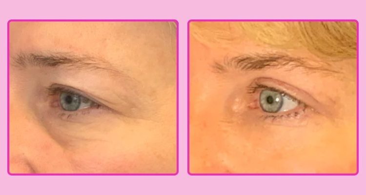 Home 10 blefaroplastica sicura, rifarsi gli occhi