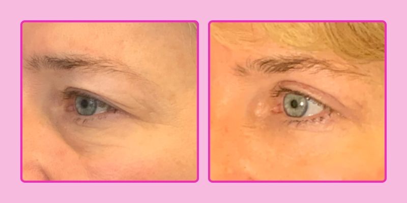 blefaroplastica sicura, rifarsi gli occhi