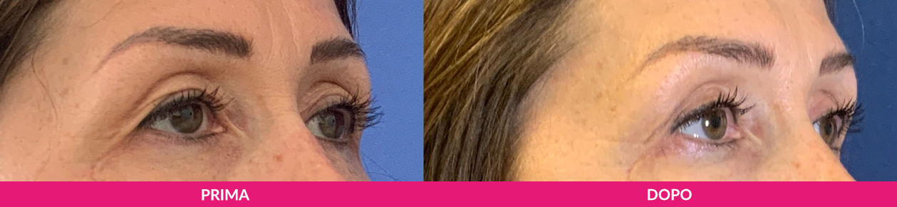 Blefaroplastica Milano 1 miglior chirurgo per la blefaroplastica a Milano, prima-dopo