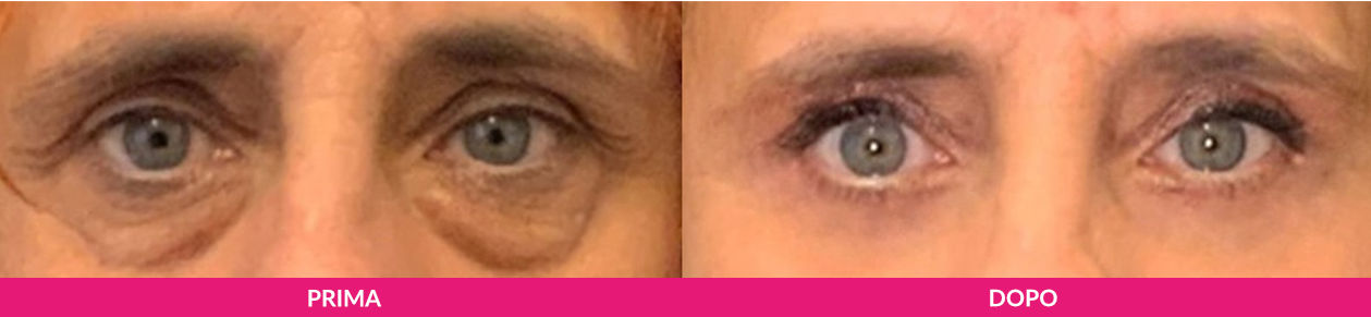 Blefaroplastica Milano 4 blefaroplastica milano, prima-dopo