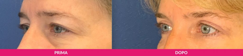 miglior chirurgo per la blefaroplastica a milano, prima-dopo, Clinica del Viso