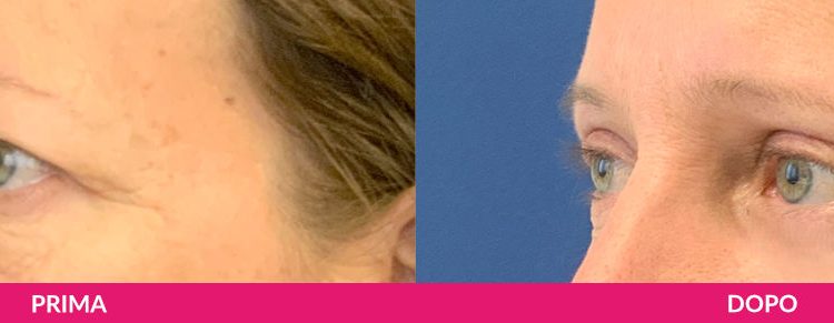 Home 10 consulenza per la blefaroplastica