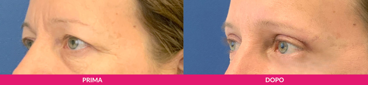 consulenza per la blefaroplastica
