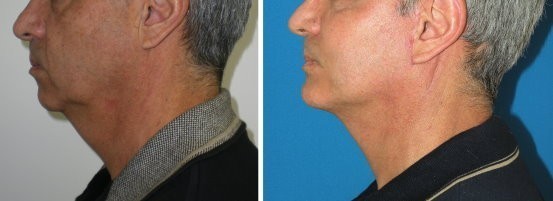 ridefinire mento e profilo mandibolare col minilifting