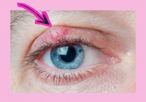 Oculoplastica per il calazio, chirurgia oculare, calazio