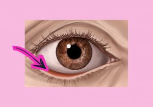 oculoplastica per l'ectropion, chirurgia oculare, ectropion