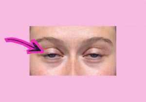 oculoplastica per ptosi palpebrale, chirurgia oculare, ptosi palpebrale