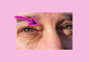 oculoplastica per xantelasmi, chirurgia oculare, xantelasmi