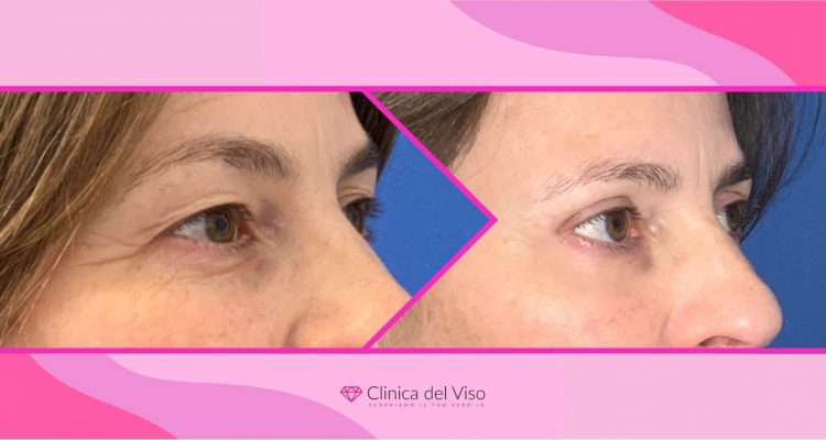 blefaroplastica: cosa si prova