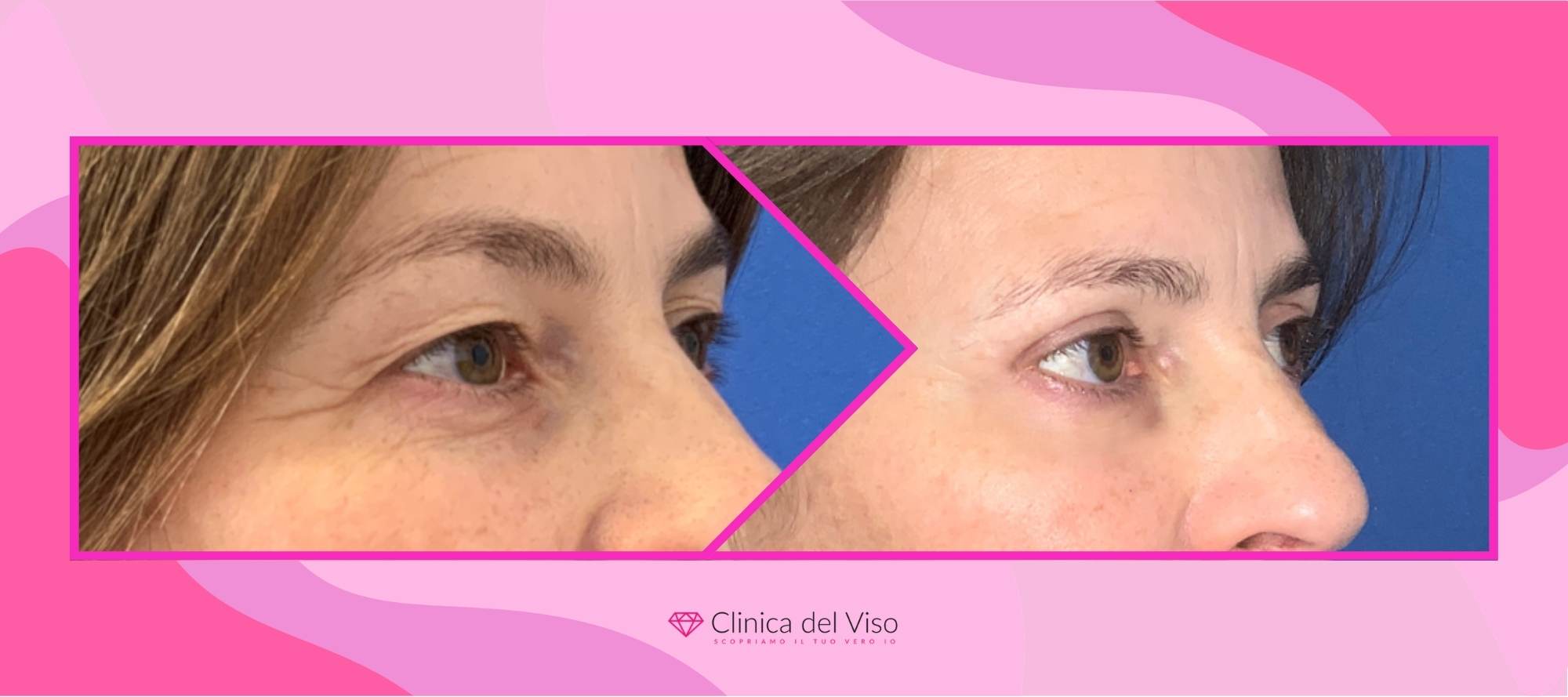 blefaroplastica: cosa si prova