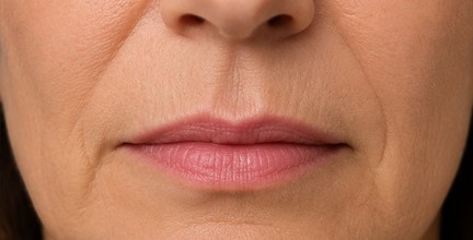 rughe attorno alla bocca, rughe delle commissure