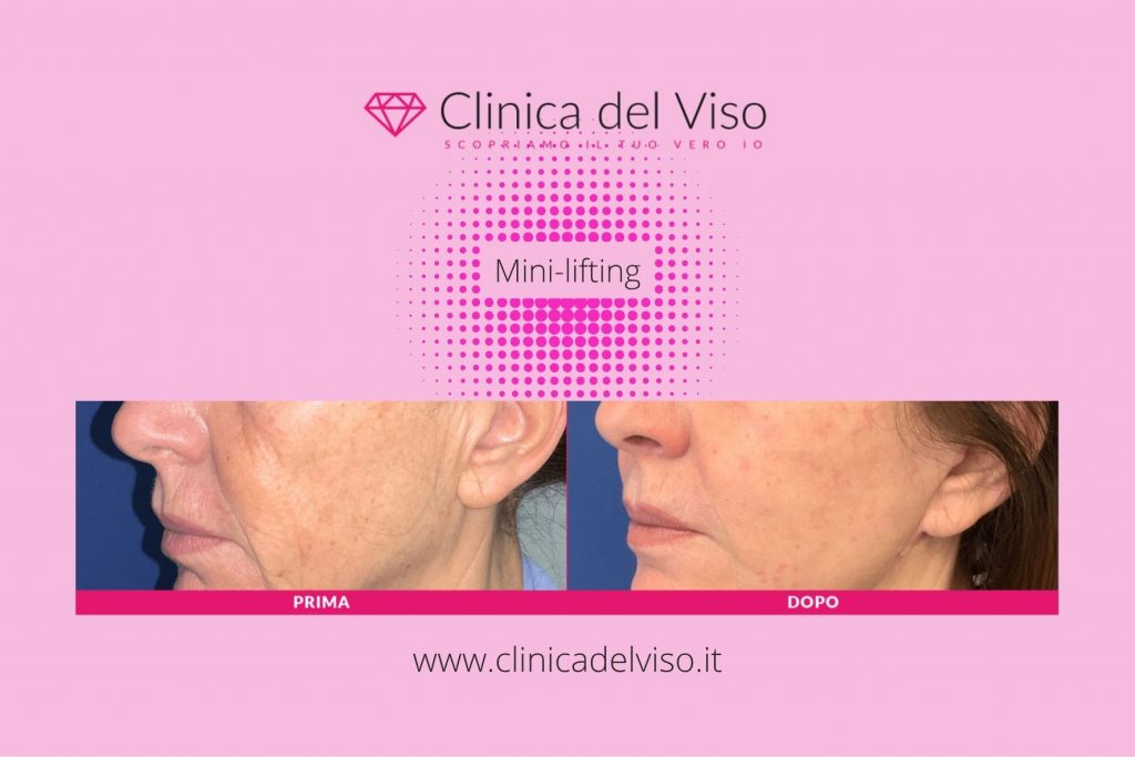 Ridefinire il profilo mandibolare: quale trattamento scegliere? 4 Ridefinire il profilo mandibolare - minilifting