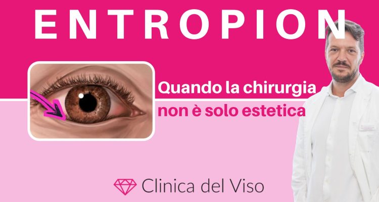 entropion, chirurgia oculare