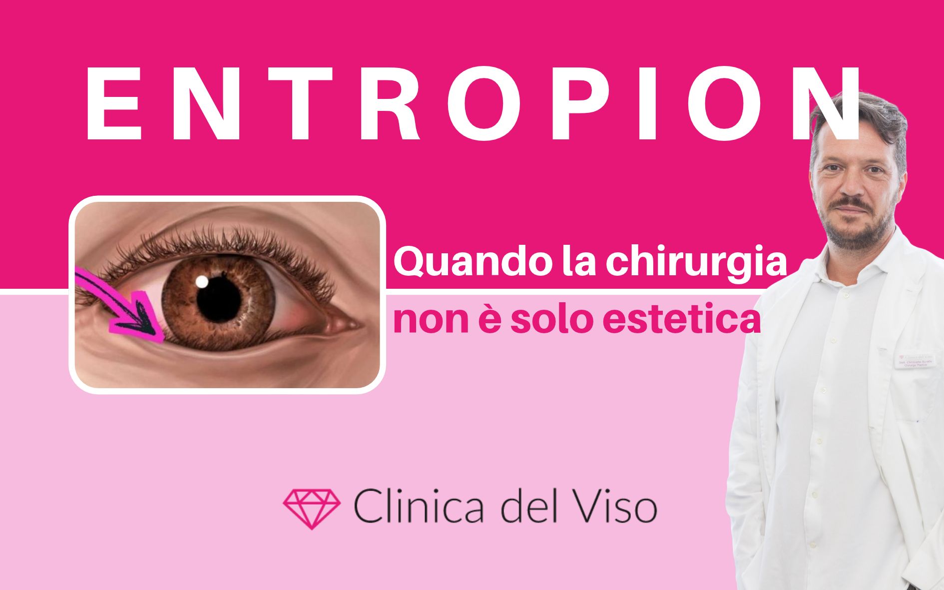 entropion, chirurgia oculare