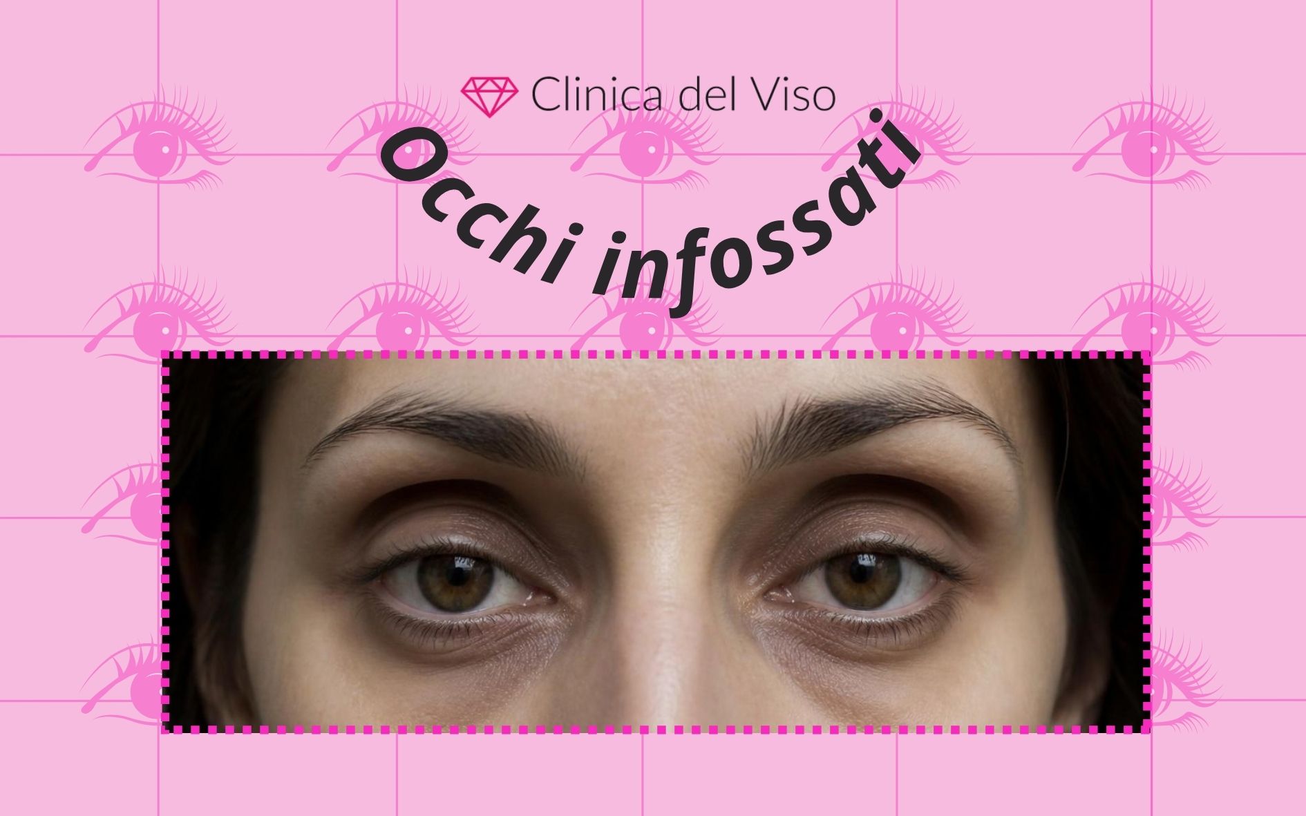 occhi infossati